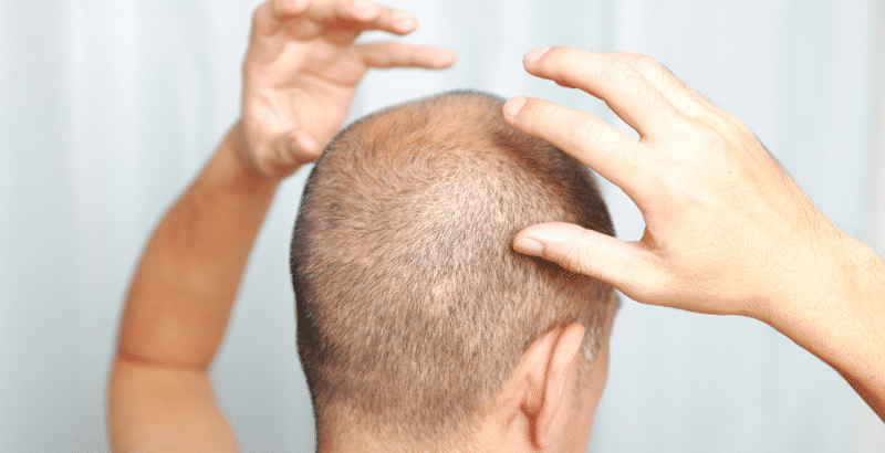 cuero cabelludo sano