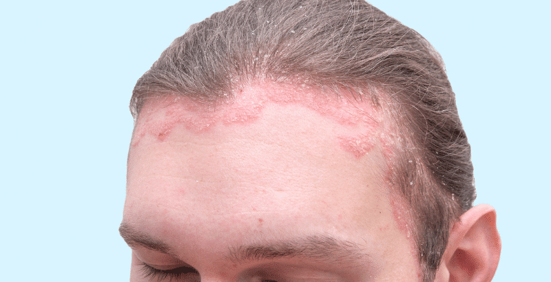 Psoriasis del cuero cabelludo