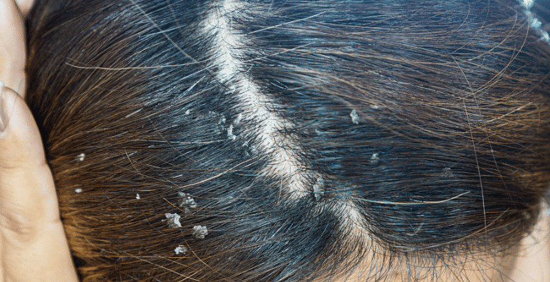 Caspa y dermatitis seborreica