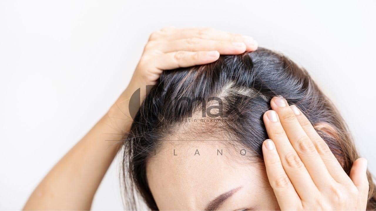 alopecia femenina