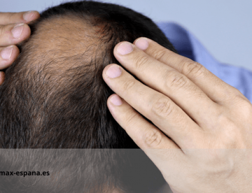 Como esconder cabelos finos no alto da cabeça