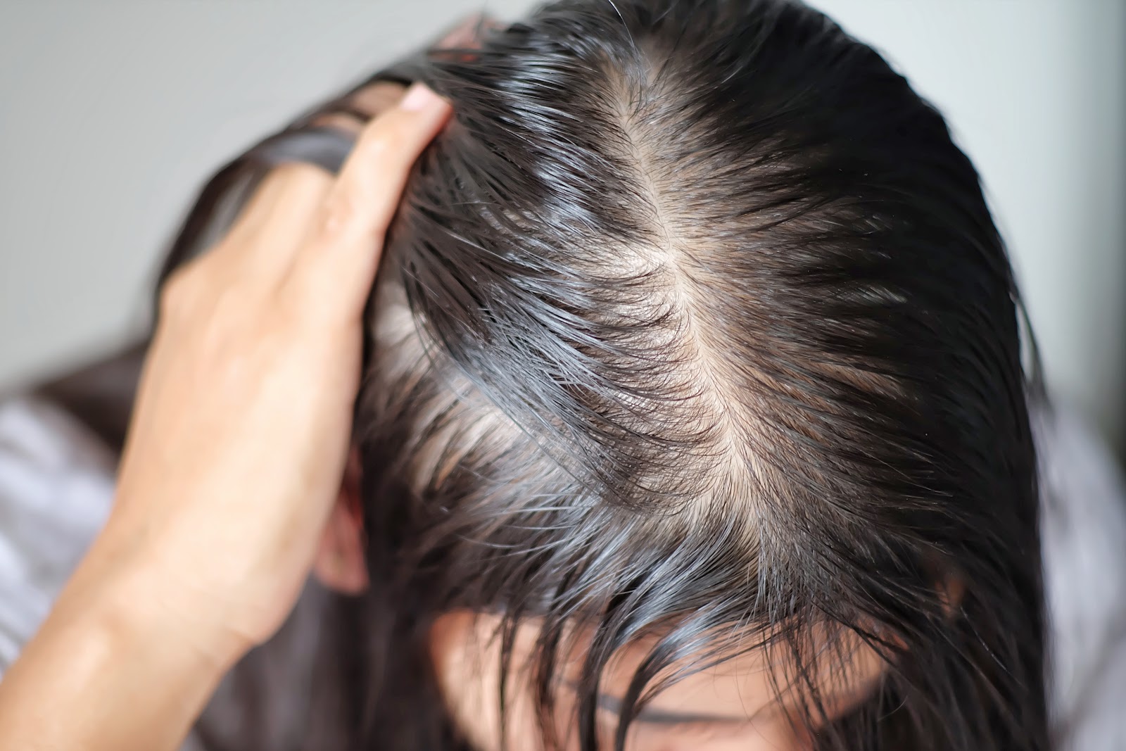 Rapariga como excesso de oleosidade no cabelo antes de iniciar um tratamento Anti-Sebo Vitaminity