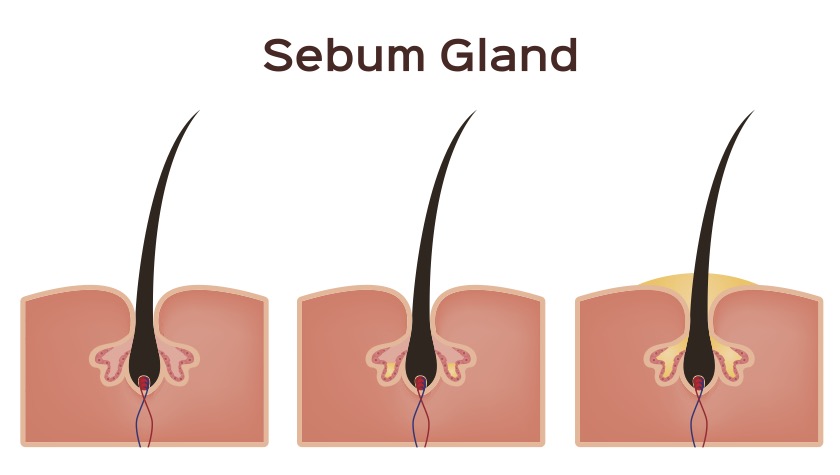 Descrição gráfica do desenvolvimento de gordura na glândula sebácea