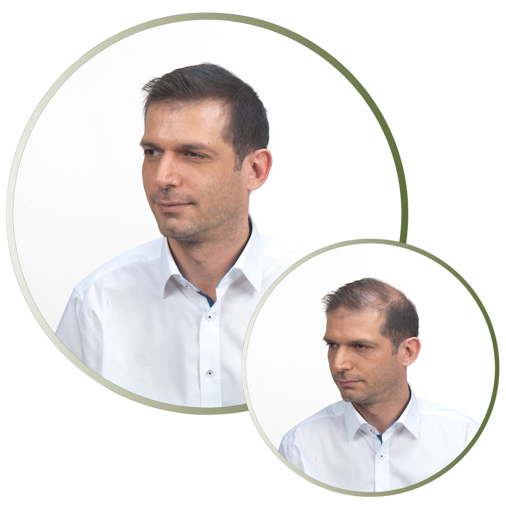 Homem_Antes e depois de utilizar as fibras capilares Kmax