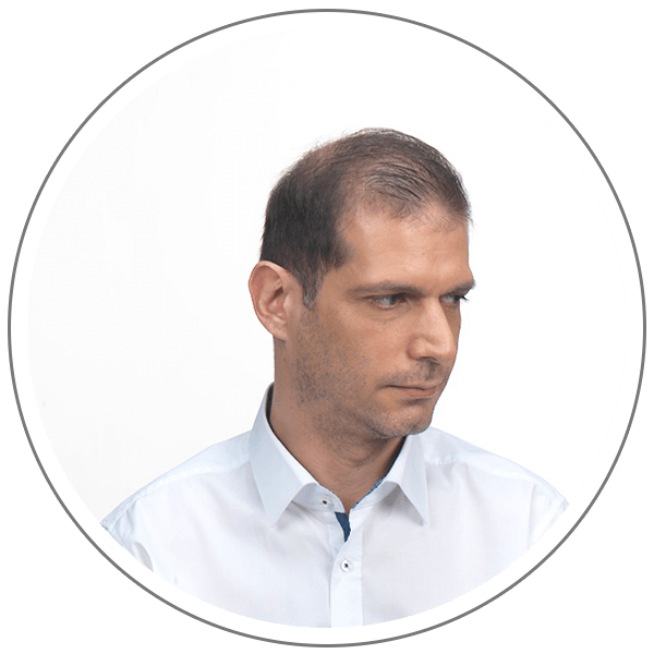 Kmax - fibras-capilares-antes-despues